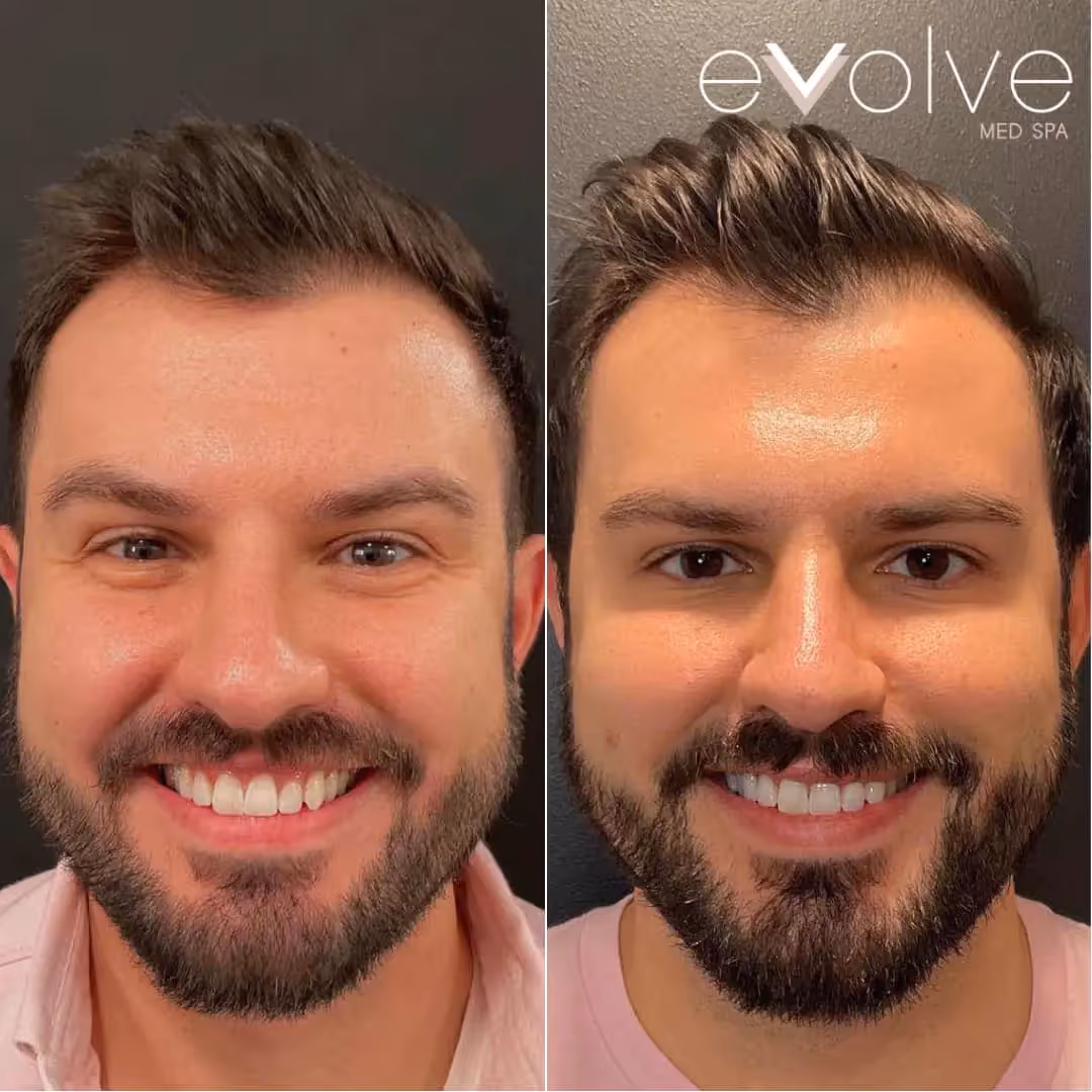 After Botox forehead treatment at MDW Aesthetics Miami