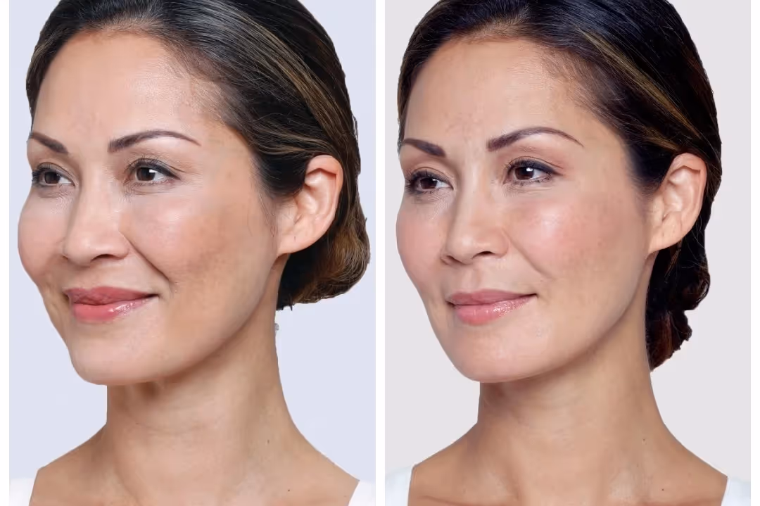 After PRP under eye treatment at MDW Aesthetics Miami