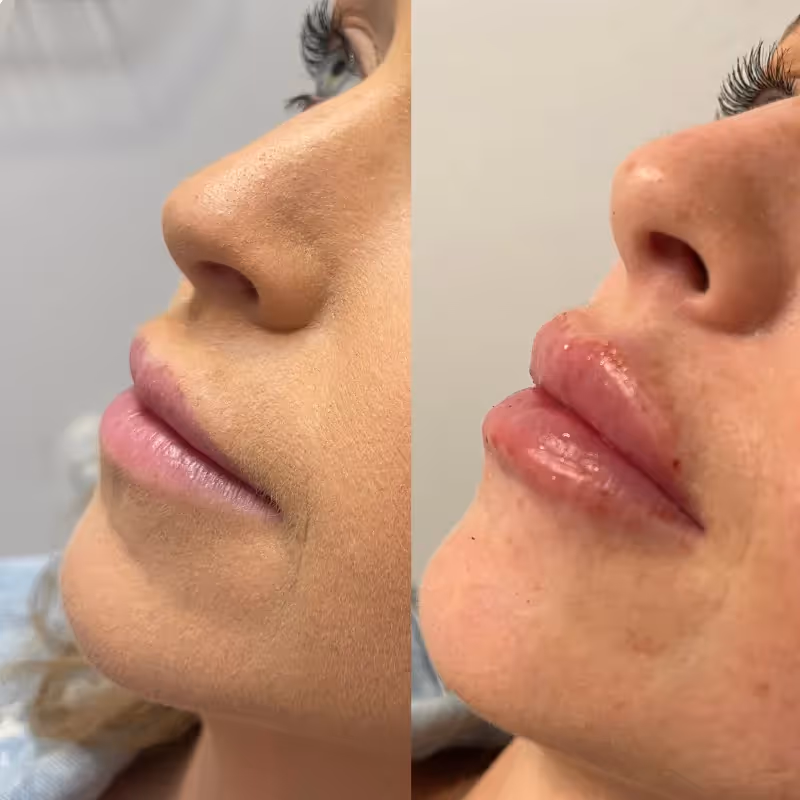 Before and after aesthetic treatment at MDW Aesthetics Miami in Brickell
