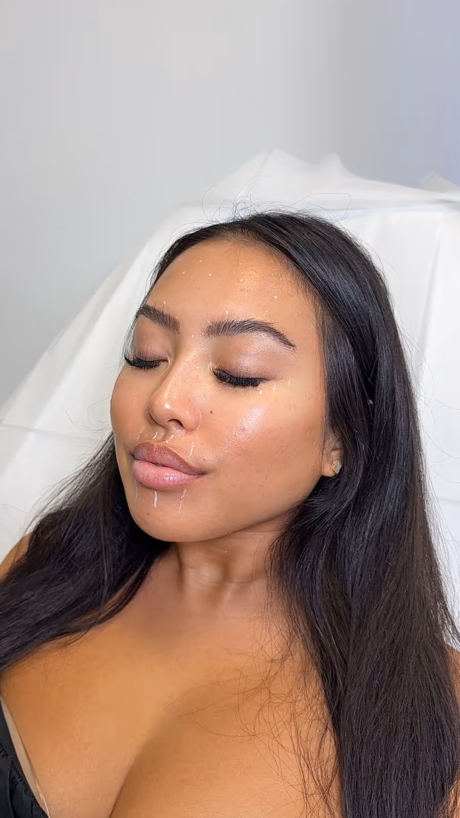 PRP Microneedling at MDW Aesthetics Miami