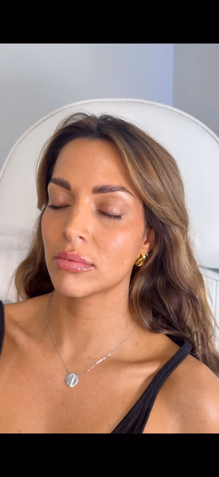 PRP Under Eye at MDW Aesthetics Miami